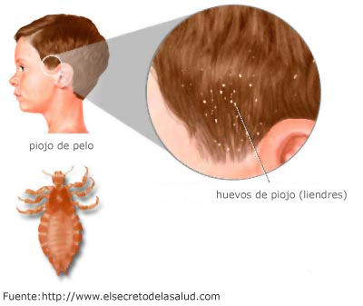 El corsé ortopédico a la hernia lumbar
